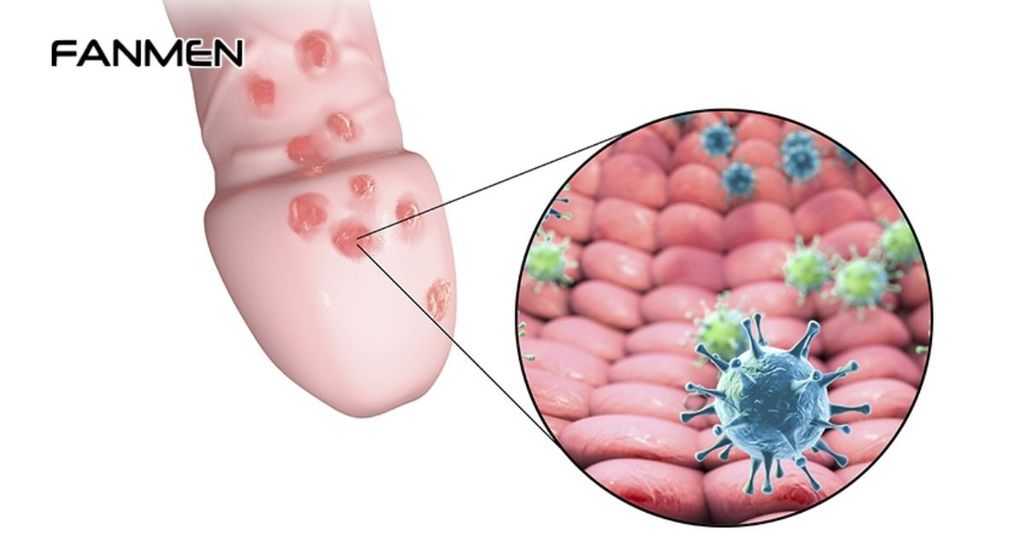 Mụn rộp sinh dục ở nam giới