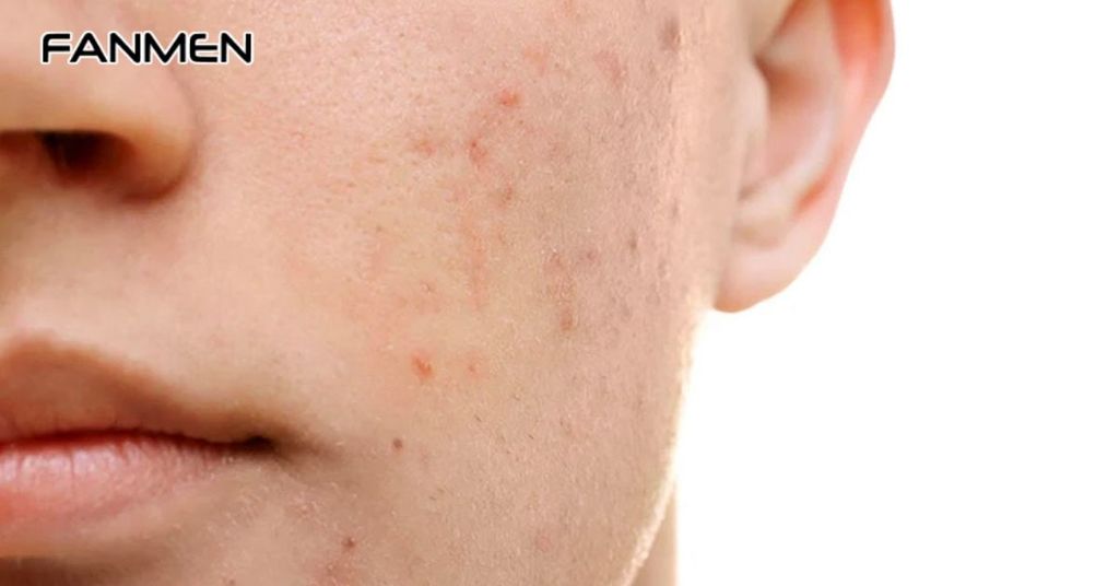 Nguyên Nhân Hình Thành Thâm Mụn Ở Nam Giới