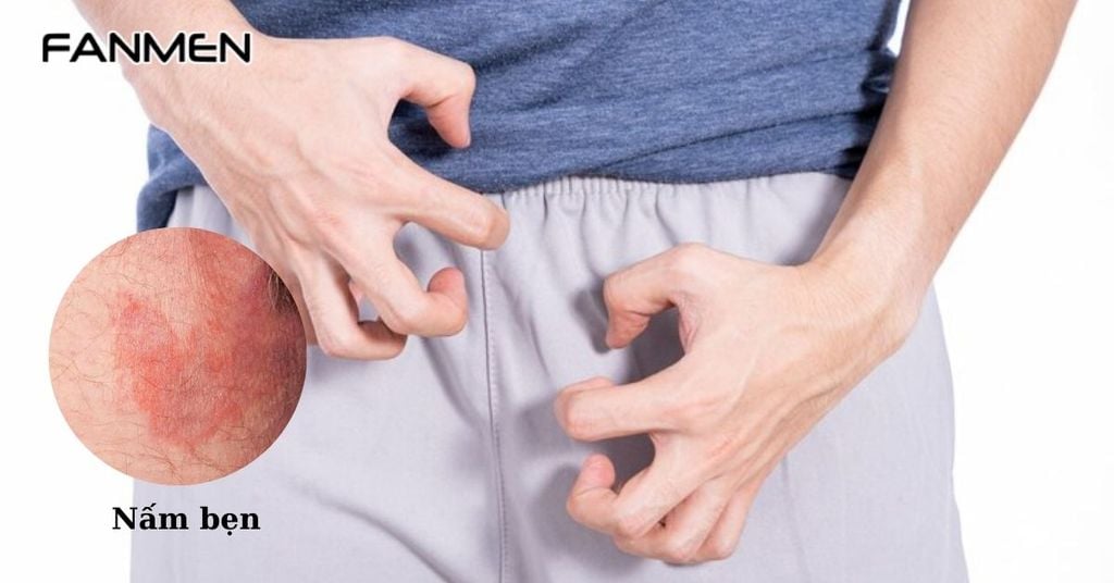 Mụn do bệnh nấm bẹn