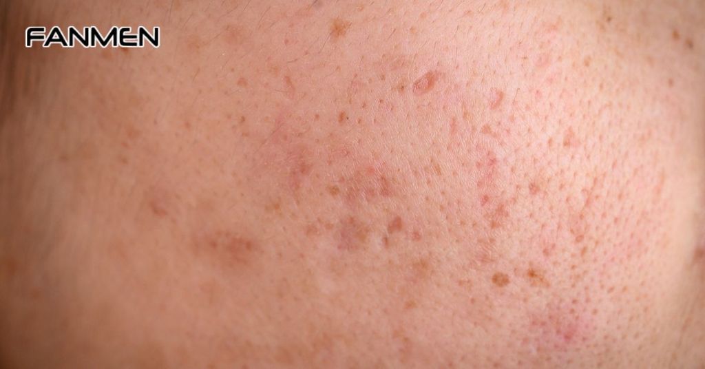 Xuất hiện nám, tàn nhang, đồi mồi