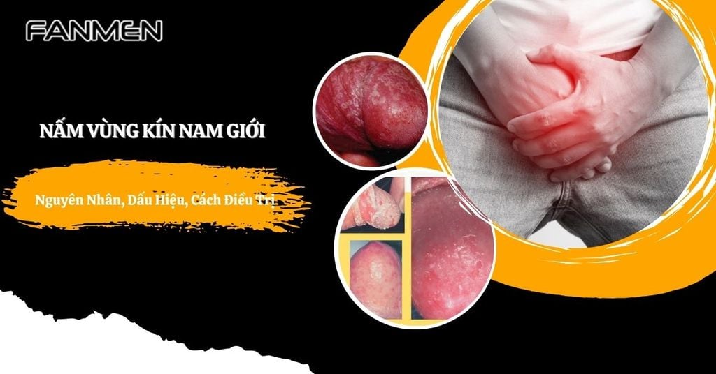 nấm vùng kín nam giới