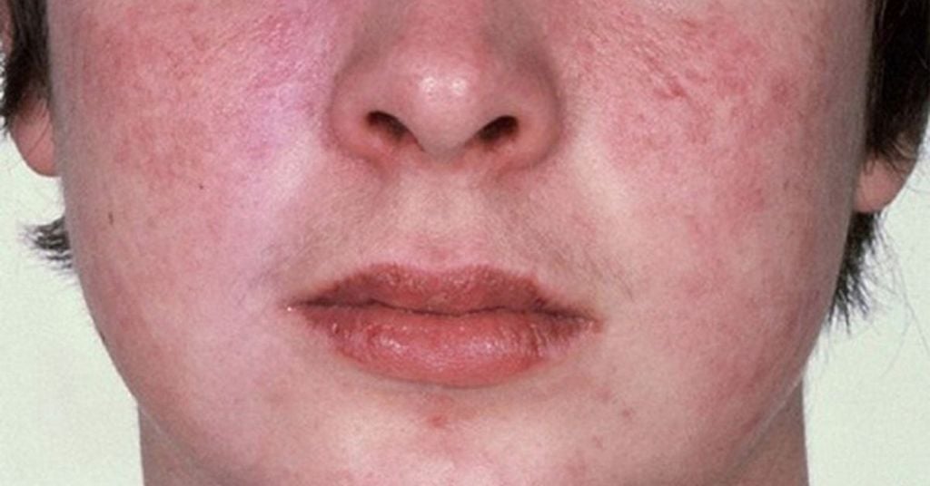 Nguyên Nhân Gây Lên Tình Trạng Da Nhạy Cảm Dễ Kích Ứng Ở Nam Giới