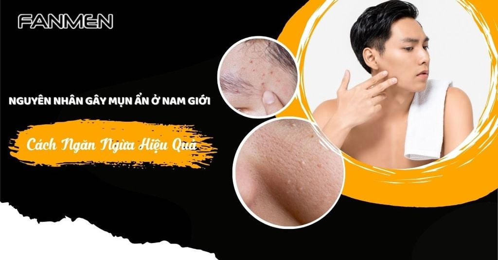 Nguyên nhân gây mụn ẩn ở nam giới