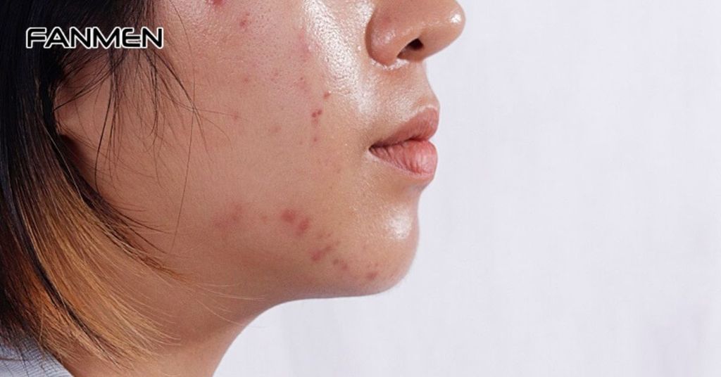 Nguyên nhân nổi mụn ở quai hàm