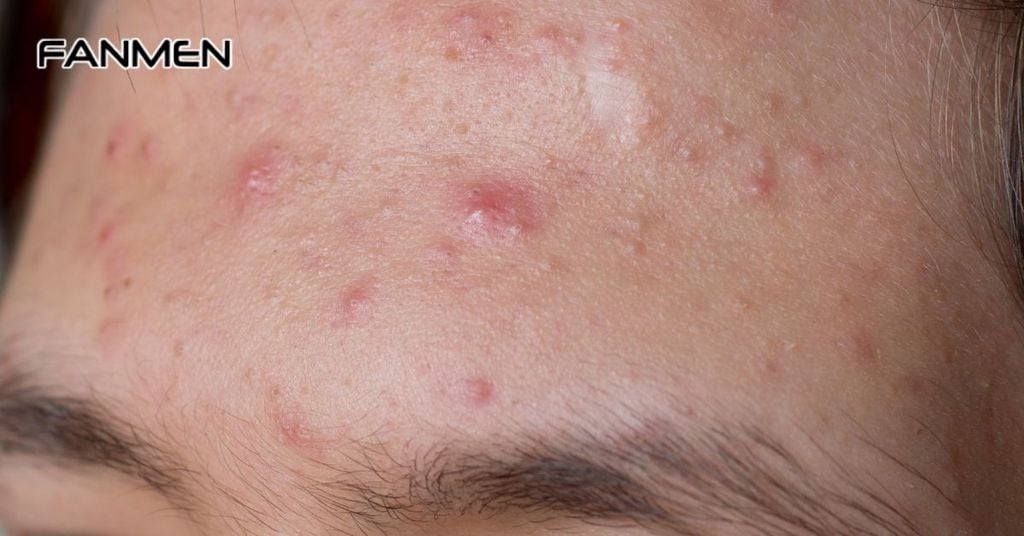 Nguyên nhân gây ra mụn ở nam giới