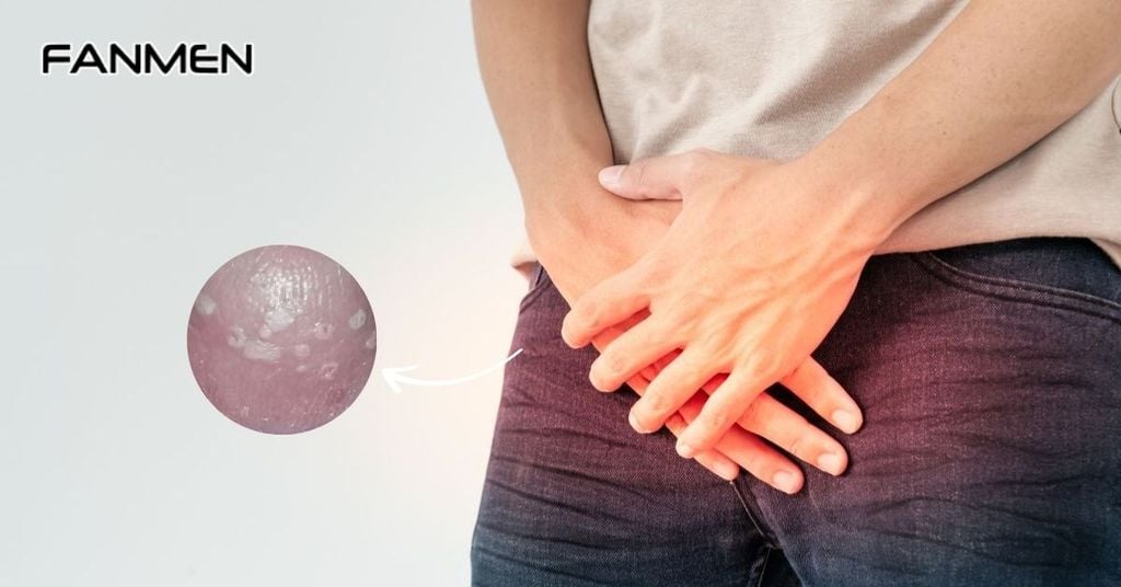Nhiễm trùng nấm men