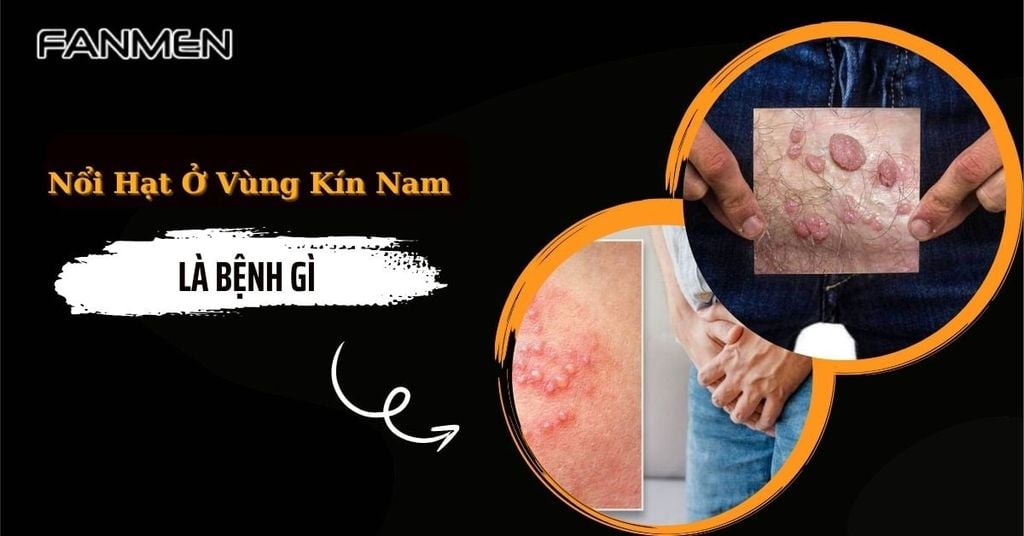 nổi hạt ở vùng kín nam