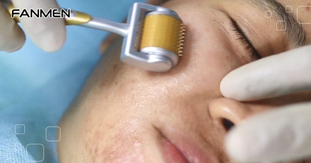 Phương pháp lăn kim