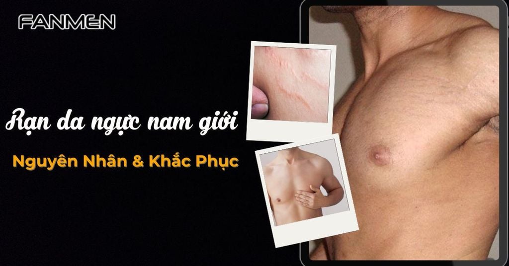 Rạn da ngực nam giới