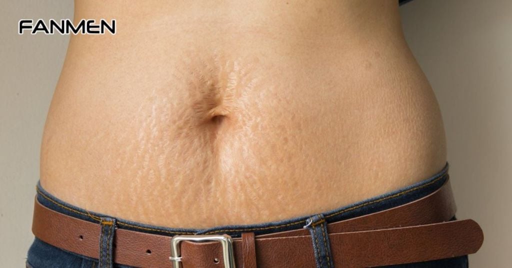 Dạn nứt da&nbsp;do tuổi dậy thì