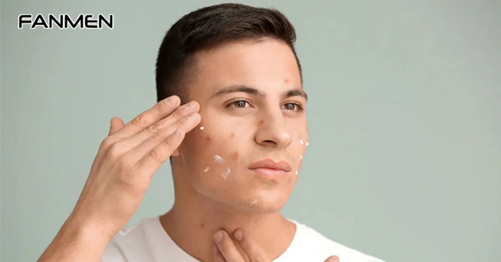 Sản phẩm trị mụn cho da dầu tốt nhất