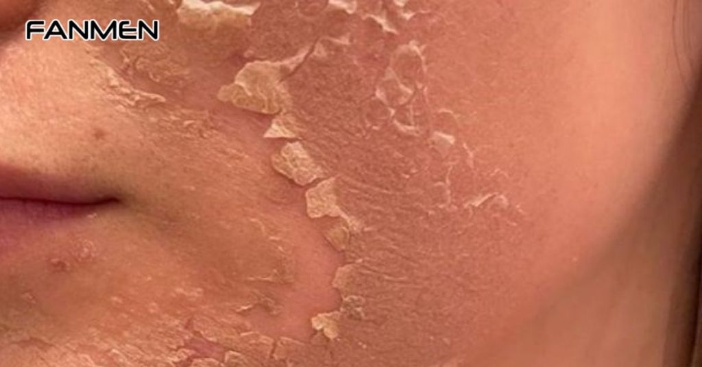 Sử dụng phương pháp peel da