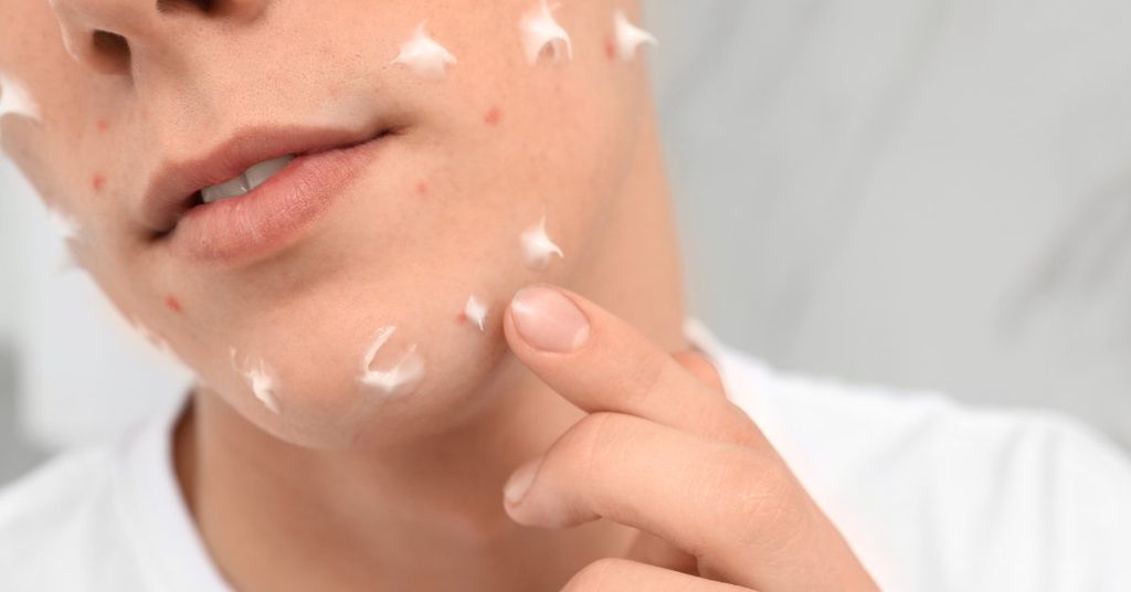 trị thâm mụn cho da hỗn hợp