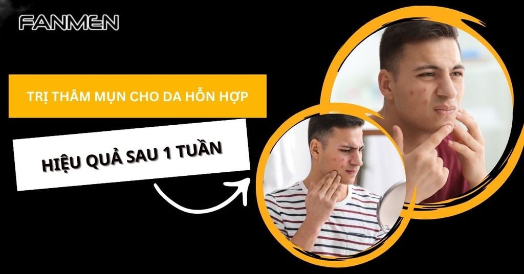 trị thâm mụn cho da hỗn hợp