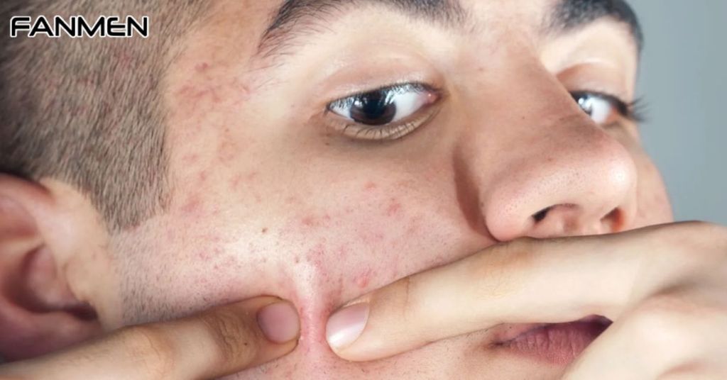 Một Số Lưu Ý Khi Chăm Sóc Da Mụn Thâm Cho Nam