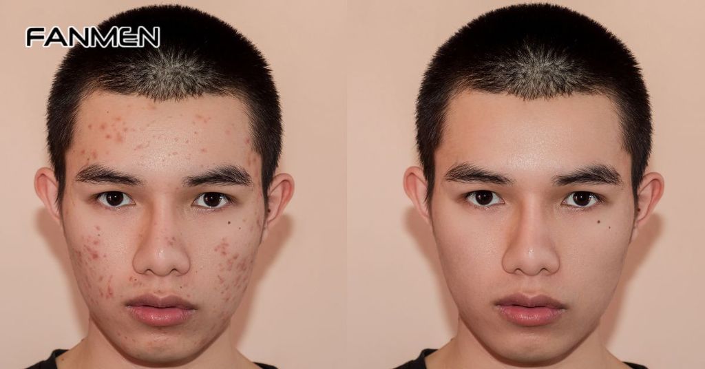 Vết thâm mụn có tự hết không?