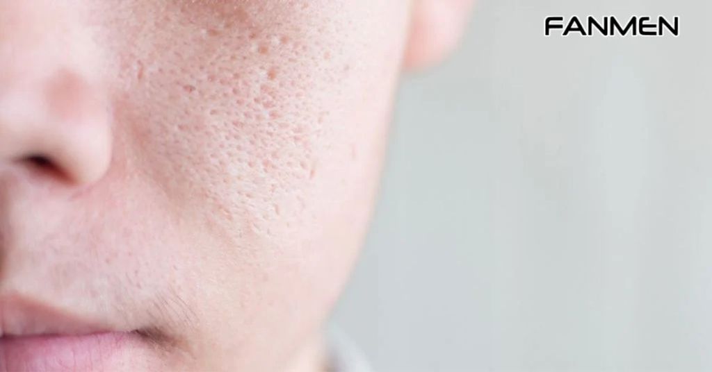 Vì sao da dầu lại có lỗ chân lông to?