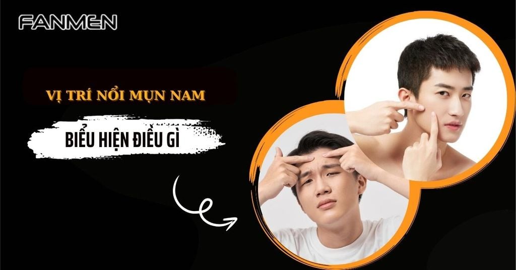 vị trí nổi mụn nam