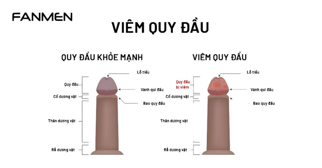 Viêm bao quy đầu