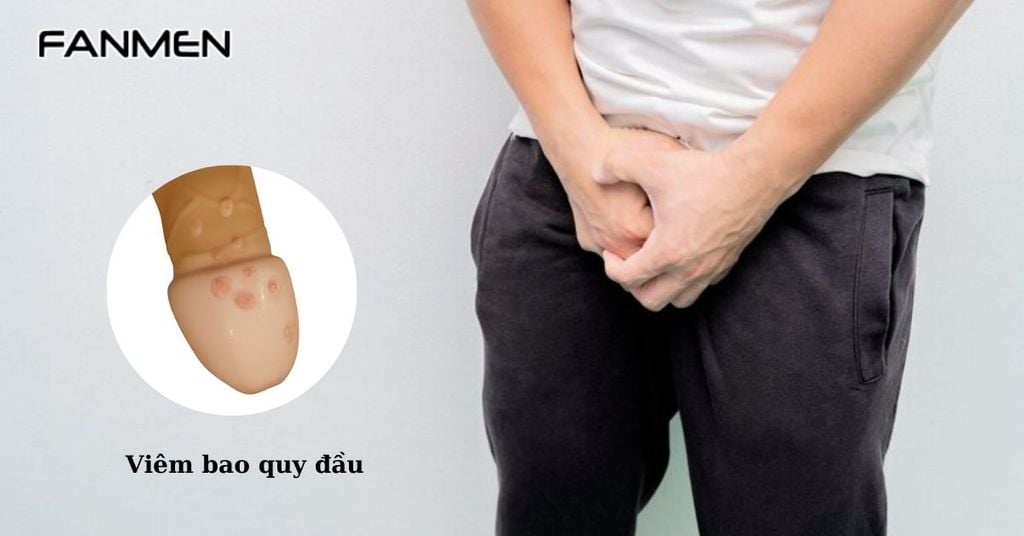 Viêm bao quy đầu