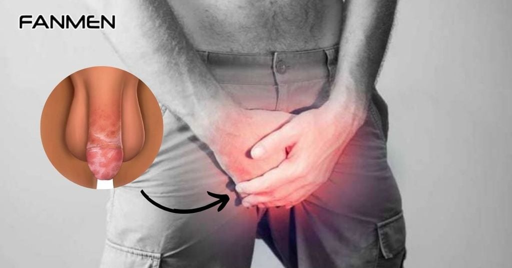 Viêm bao quy đầu