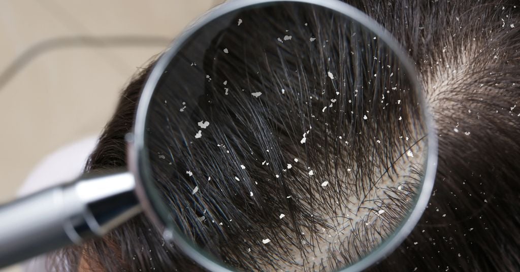 Rụng tóc nhiều ở nam: Nguyên nhân và cách khắc phục chi tiết