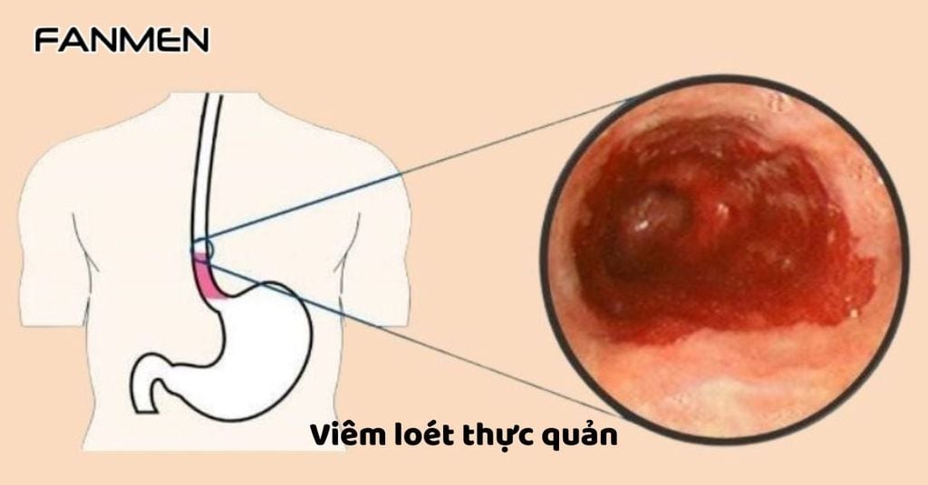 Viêm loét thực quản và niêm mạc miệng