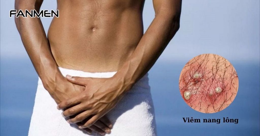 Bị nổi mụn ở vùng kín nam do viêm nang lông