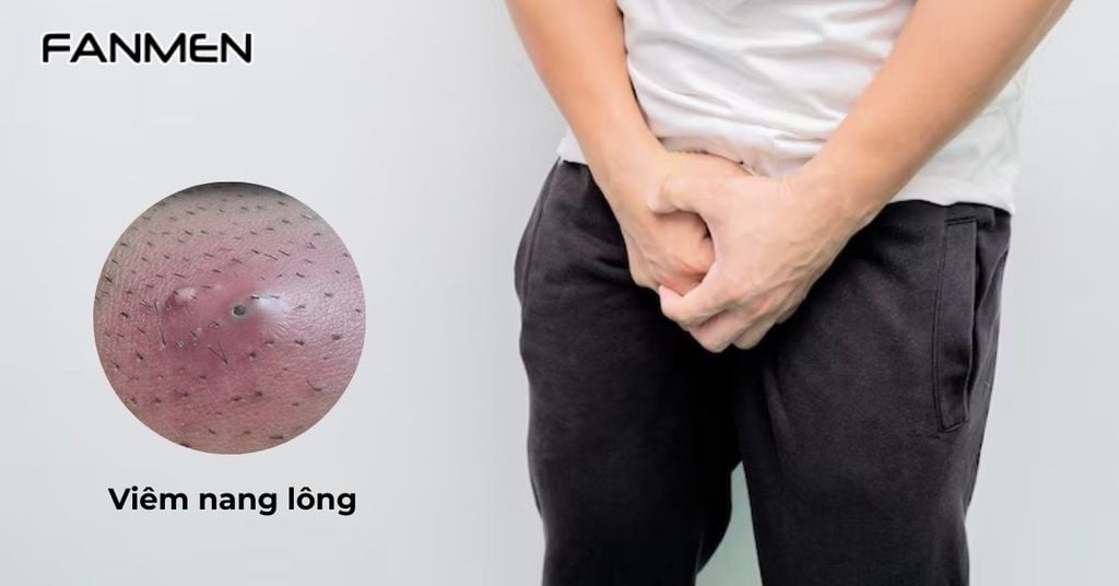 Nổi mụn cứng ở vùng kín nam do viêm nang lông
