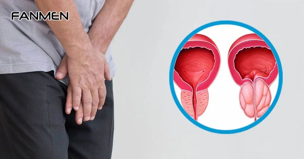 Viêm tuyến tiền liệt